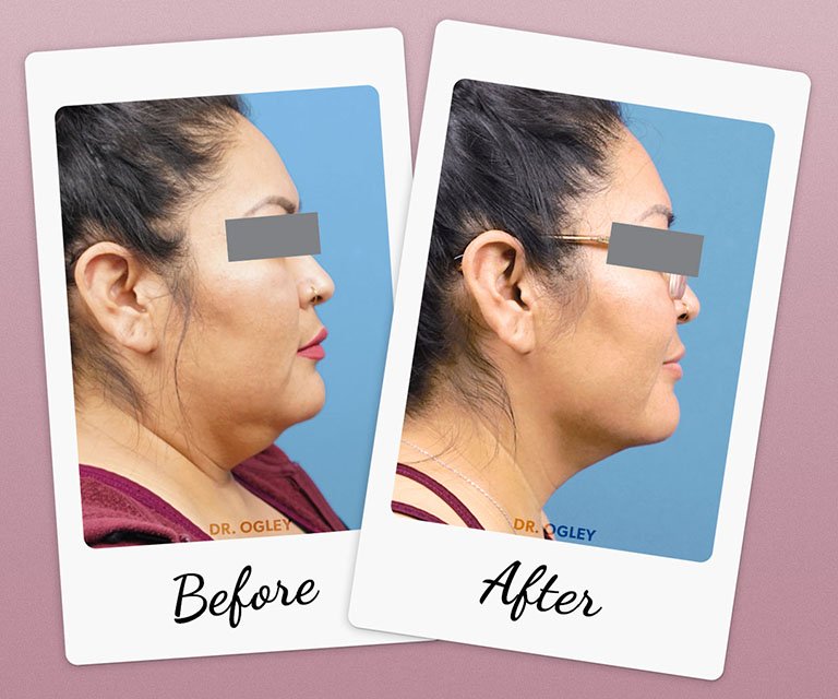 Neck Liposuction before and after