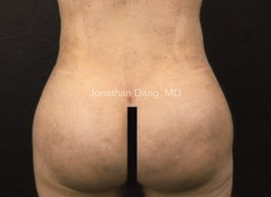 Patient after liposuction and brazilian butt lift - photo courtesy of Dr. Dang
