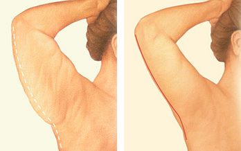 arm tuck incision diagram