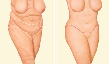 body lift marking diagram