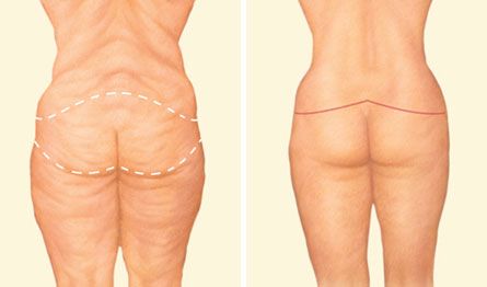 buttock lift marking diagram