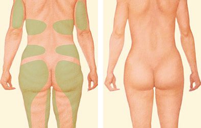 liposuction of back diagram