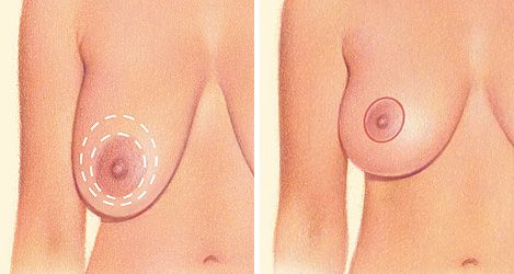 Periareolar breast lift diagram