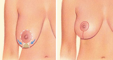Vertical breast lift diagram