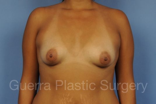 Case #1004005 Before