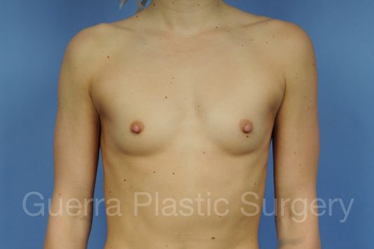 Case #1002164 Before