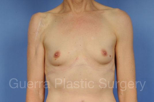 Case #1002161 Before