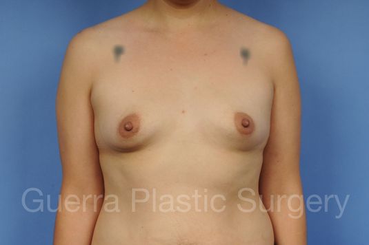 Case #1002160 Before