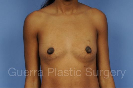 Case #1002158 Before