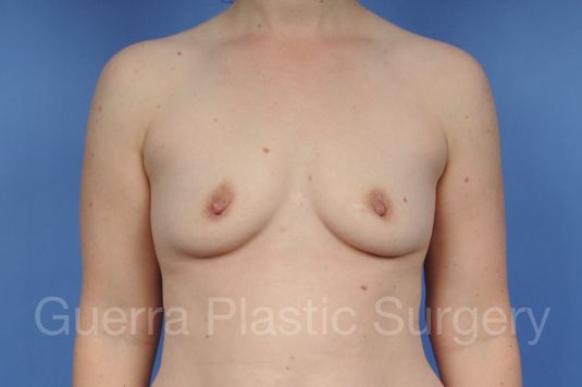 Case #1002157 Before