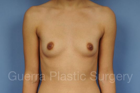 Case #10020173 Before