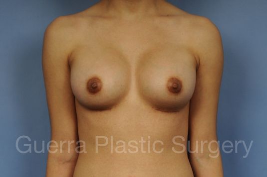 Case #10020173 After