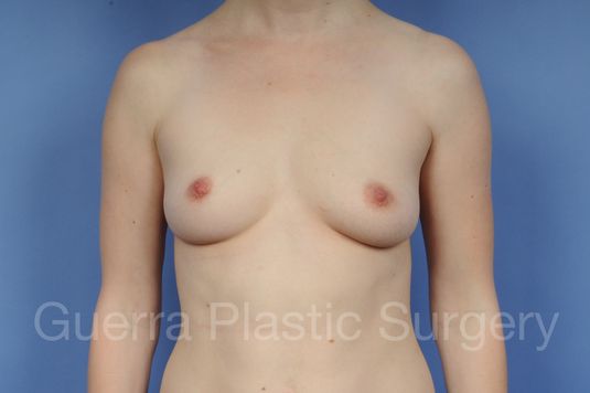 Case #1002174 Before