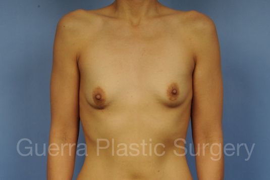 Case #1002175 Before