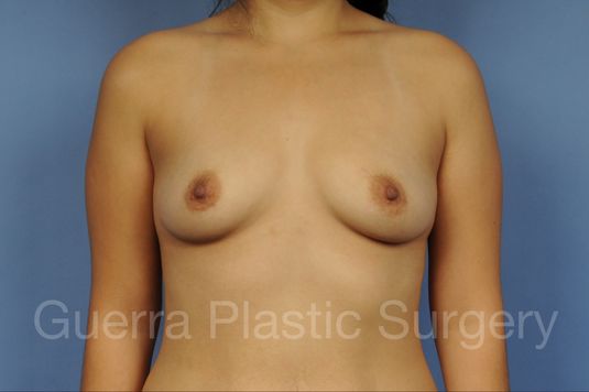 Case #1002179 Before