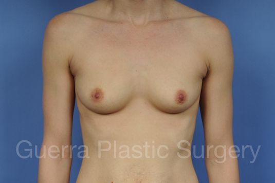 Case #1001175 Before