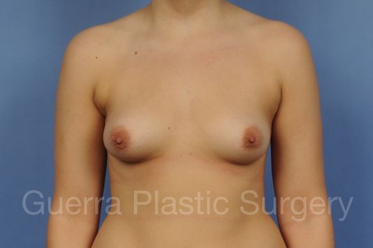 Case #1001176 Before