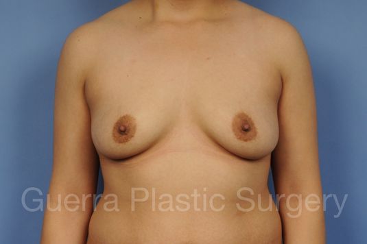 Case #1001177 Before