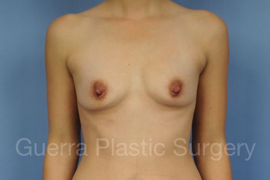 Case #1001178 Before