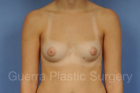 Case #1001180 Before