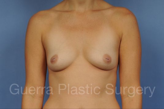 Case #1005001 Before