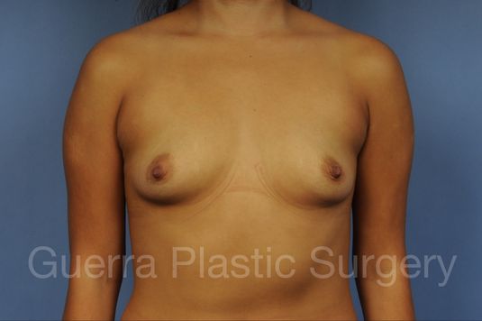 Case #10020171 Before