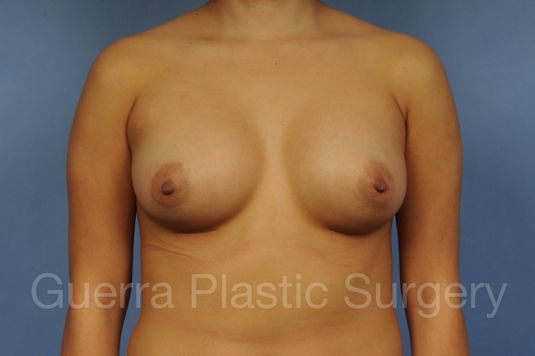 Case #10020171 After