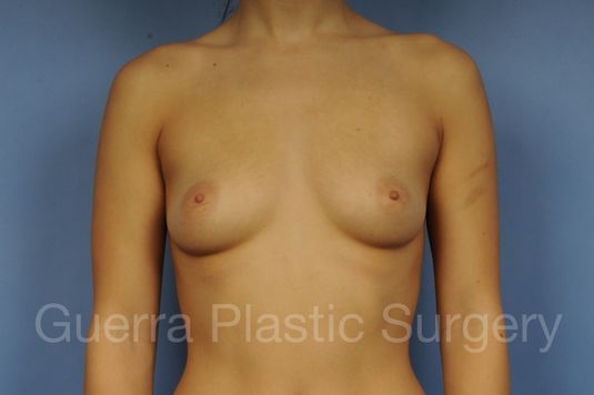 Case #1002170 Before