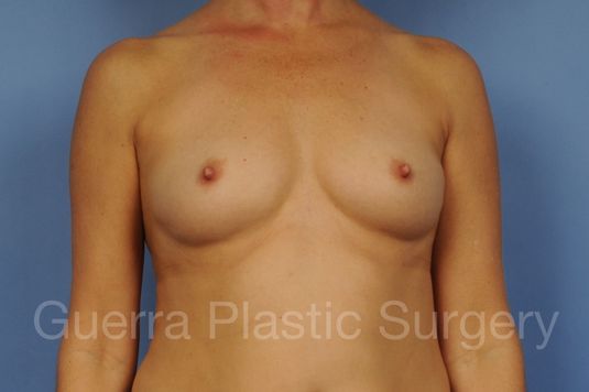 Case #1002169 Before