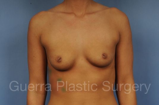 Case #1002041 Before