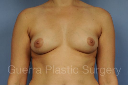 Case #1002182 Before