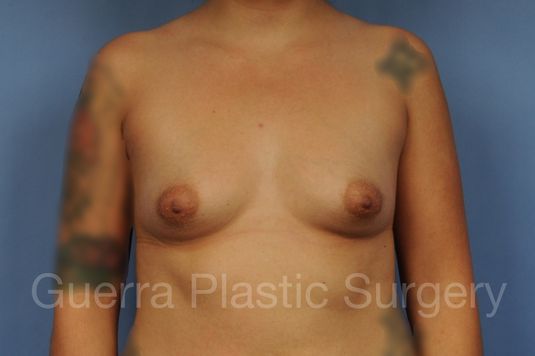 Case #1002184 Before