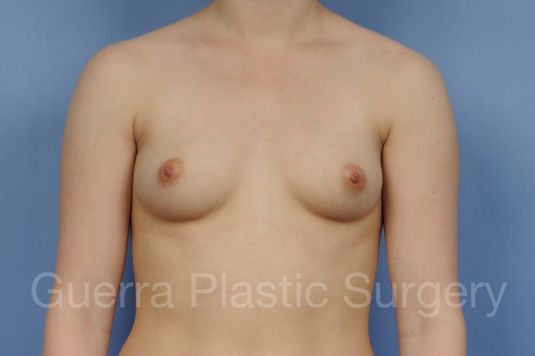 Case #1002185 Before