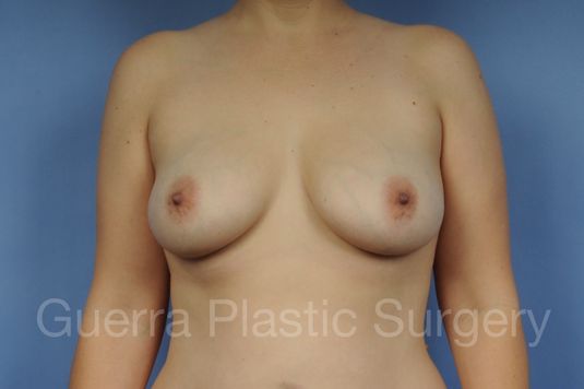 Case #1002186 Before