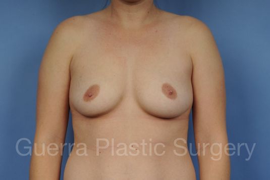 Case #1002187 Before