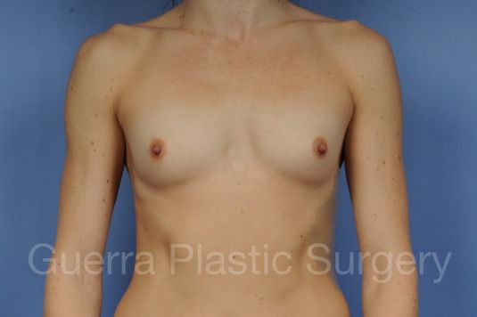 Case #1001183 Before