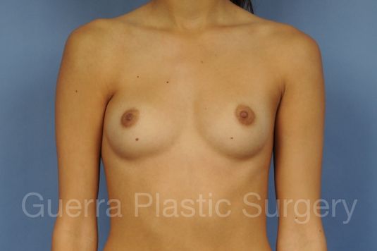 Case #1001184 Before