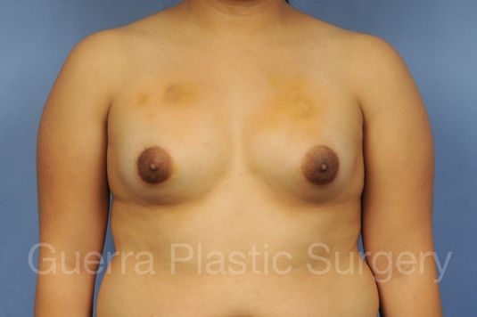 Case #1001186 Before