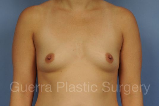 Case #1001187 Before