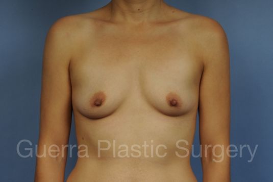 Case #1001189 Before