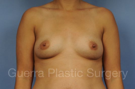 Case #1001190 Before