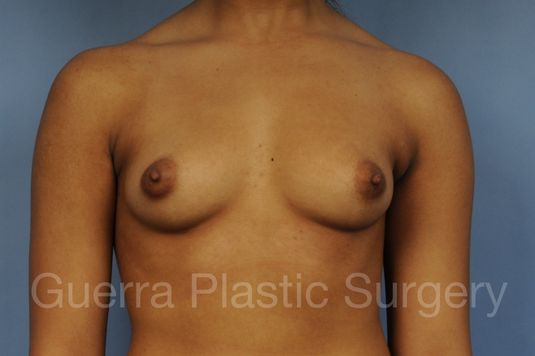 Case #1001191 Before