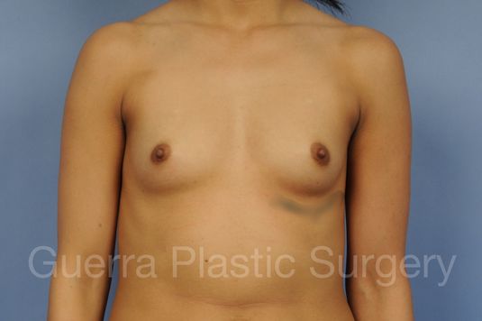 Case #1001192 Before