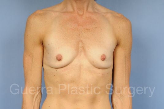 Case #1001193 Before