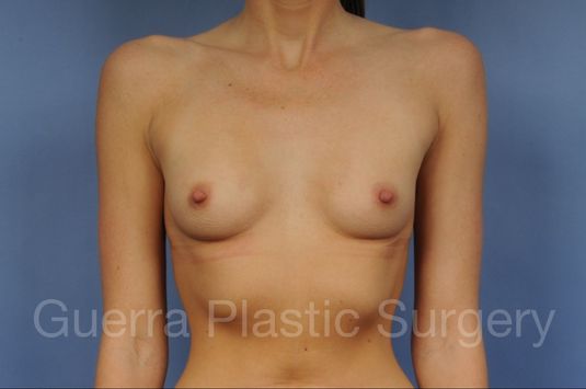 Case #1001194 Before