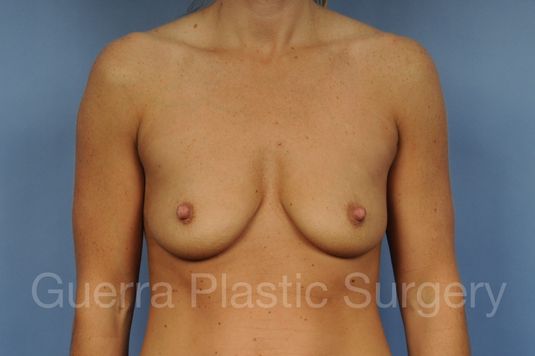 Case #1001198 Before