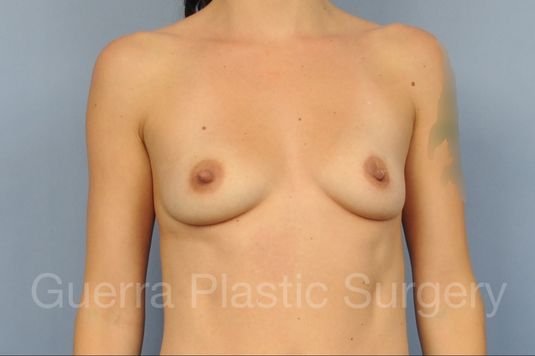 Case #1001199 Before