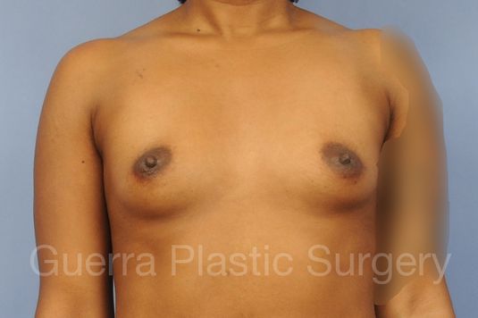 Case #1001200 Before