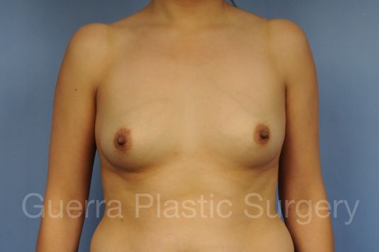 Case #1001201 Before