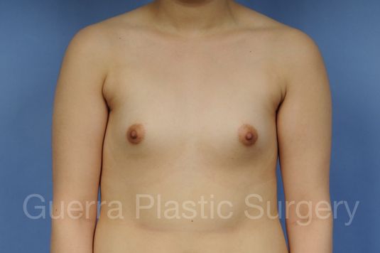 Case #1001203 Before